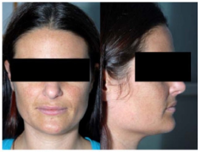 The Progression of Addison Disease: From Subclinical to Adrenal Failure